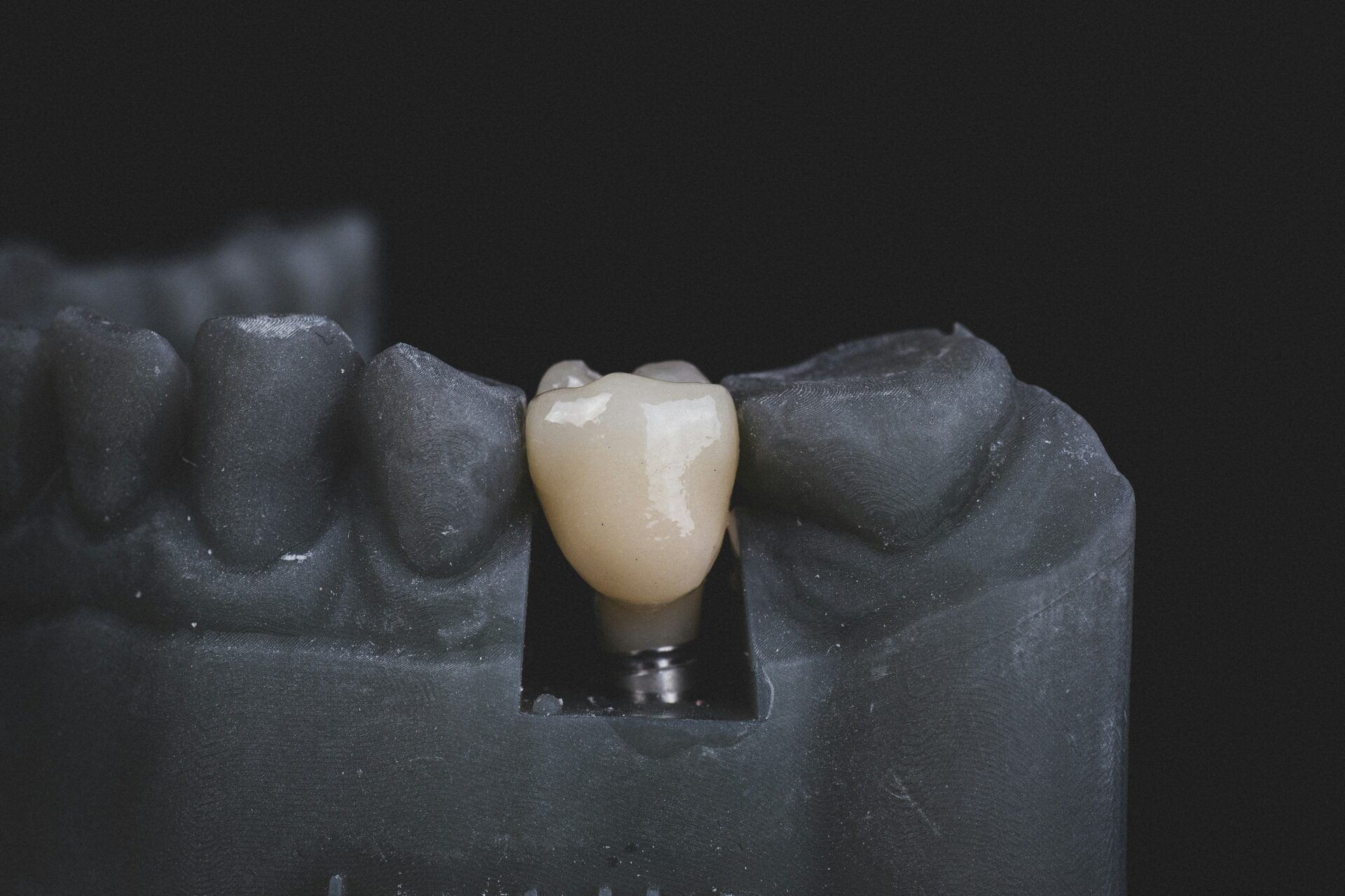 An implant-supported dental crown on a model
