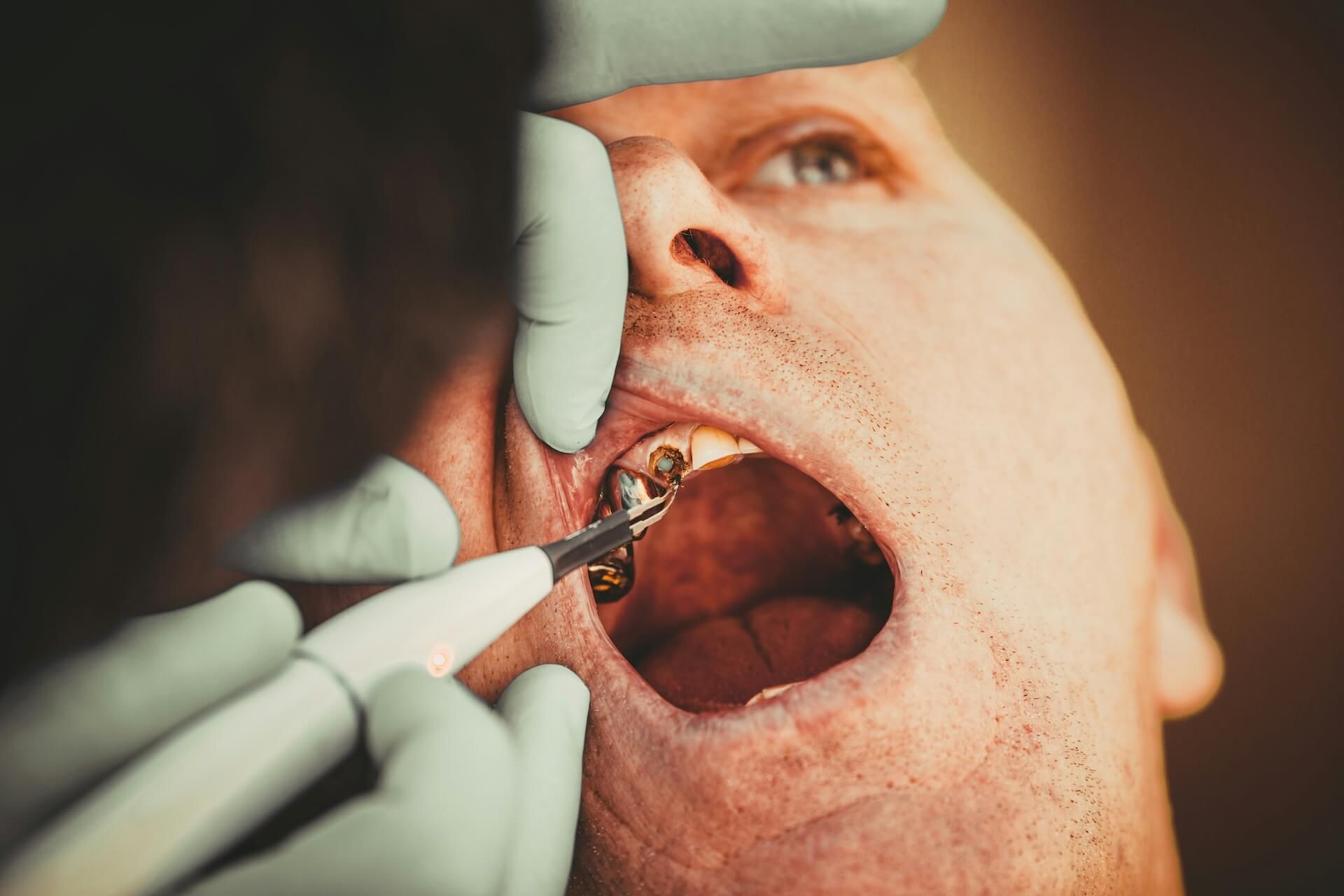 A dentist treating a patient’s damaged back tooth