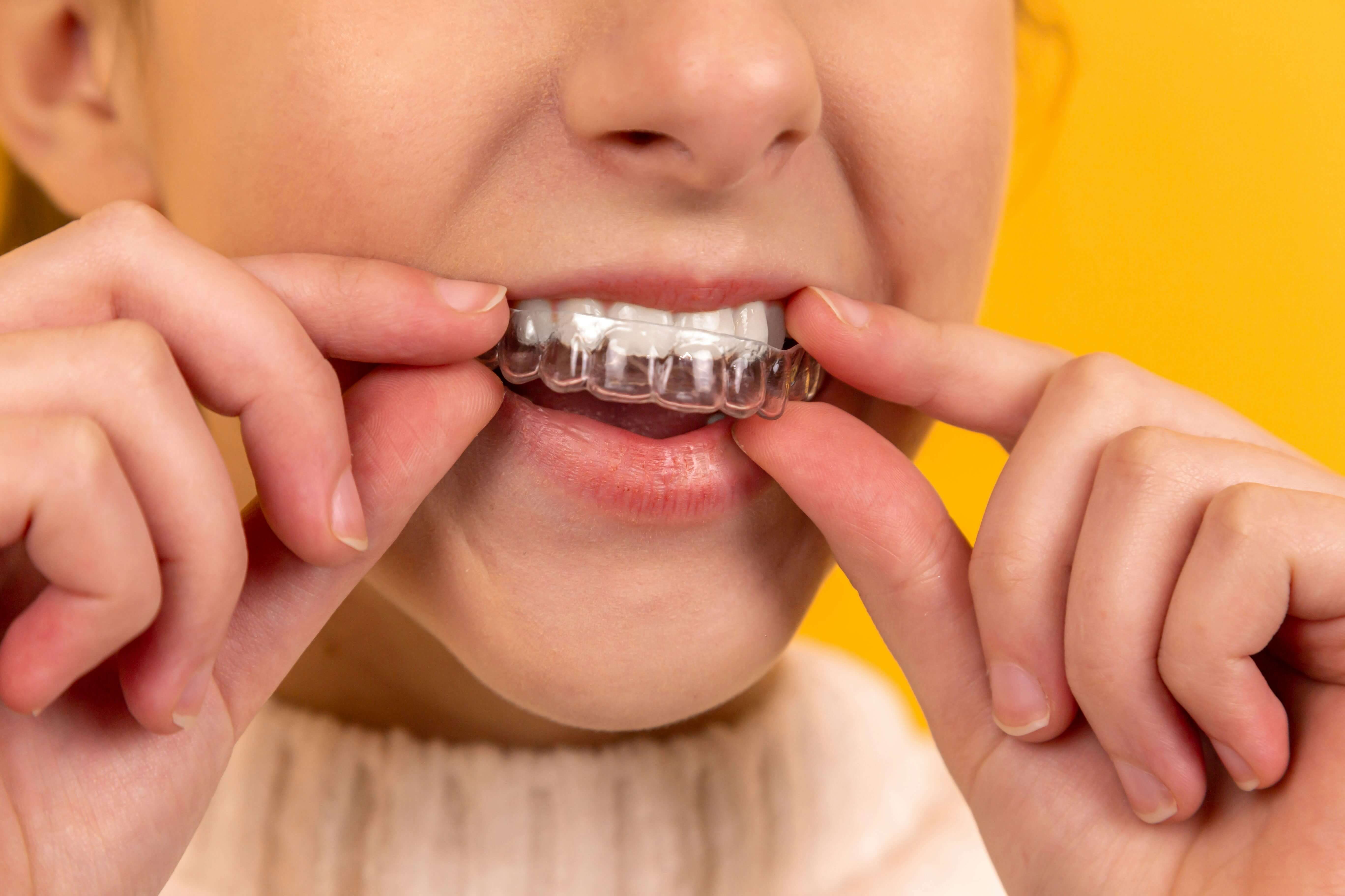 A person placing a clear dental aligner over their upper teeth