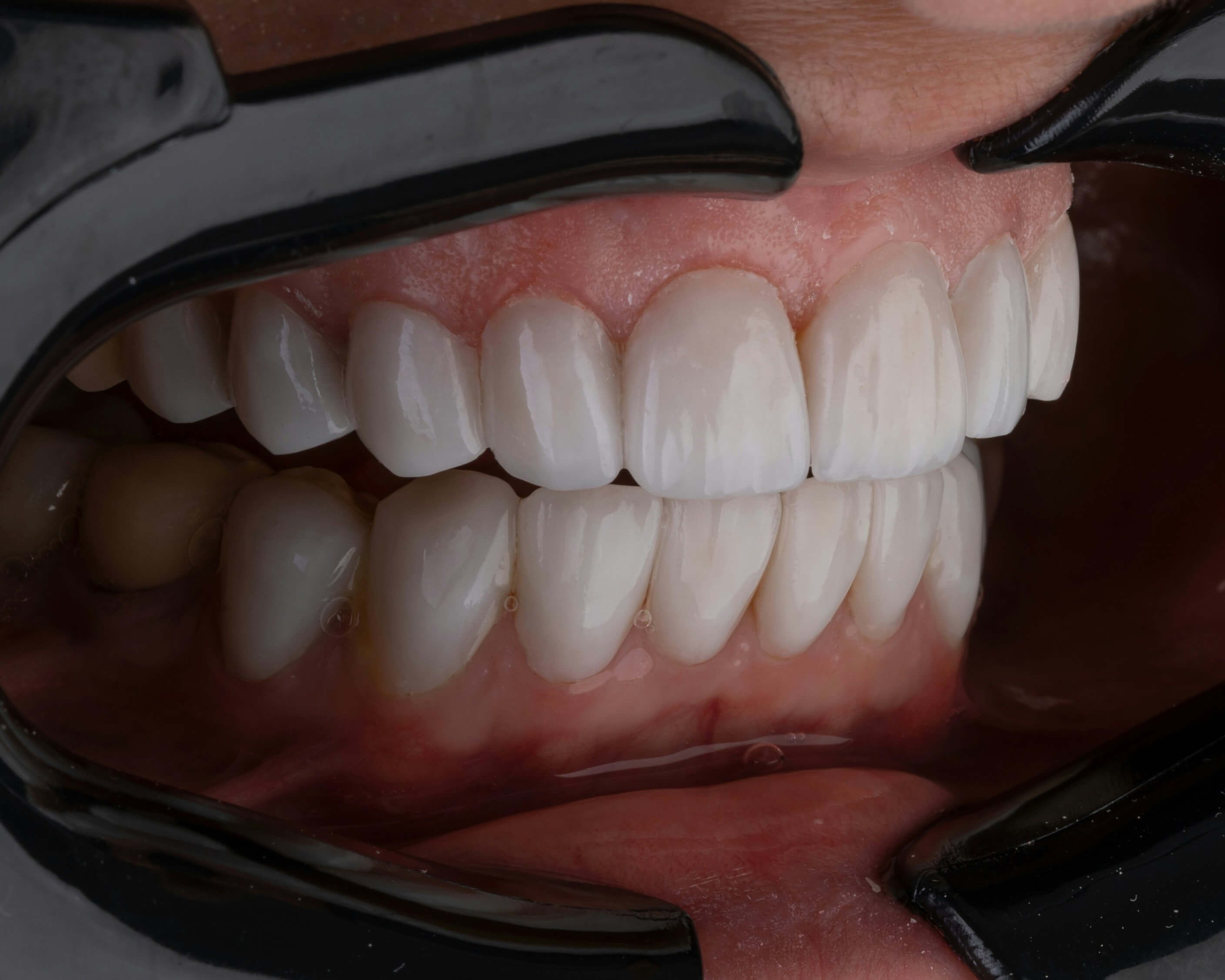 A close-up view of custom porcelain veneers